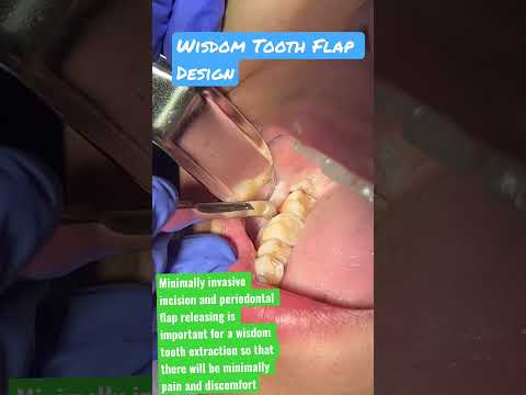 Wisdom Tooth Flap Design (How To Remove Wisdom Tooth)