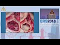 Ers london 2018 sinonasal malignancy valerie lund