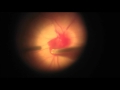 Embolectomy for retinal artery occlusion results in branch retinal artery avulsion