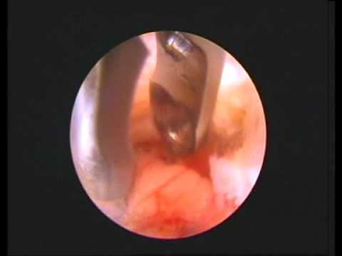 Video Beeld endoscopische hernia operatie