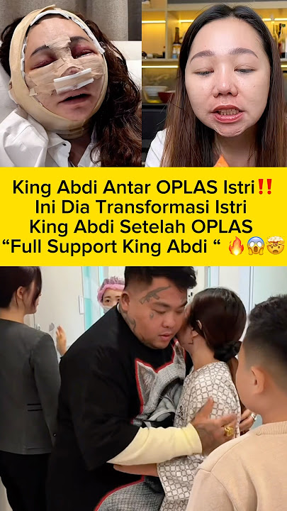 KING ABDI FULL SUPPORT ISTRI OPLAS ‼️Transformasinya Bikin Kaget 🔥😱 #kingabdi #oplas #fyp #viral