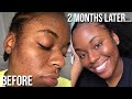 How I Faded my Acne Scars + Dark Marks FAST🙏🏾| Skincare Routine for Uneven Complexion| LexsaMarie