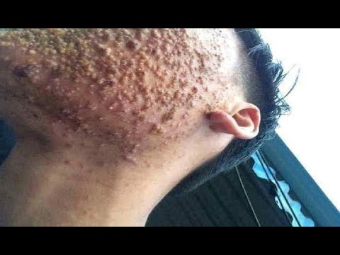 worst acne blackhead treatment