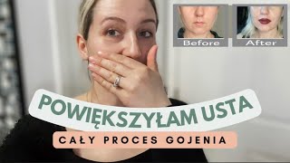 Powiekszyłam Usta Pierwszy Raz