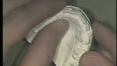 Wire Bending for Removable Acrylic Appliances