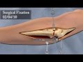 3D Surgical Animation of Elbow Injury