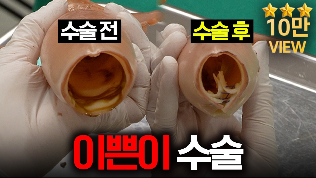손가락 3개 들어가던 질… 수술 후 이렇게 달라집니다 (보험도 가능?)