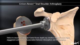Univers Revers™ Total Shoulder Arthroplasty