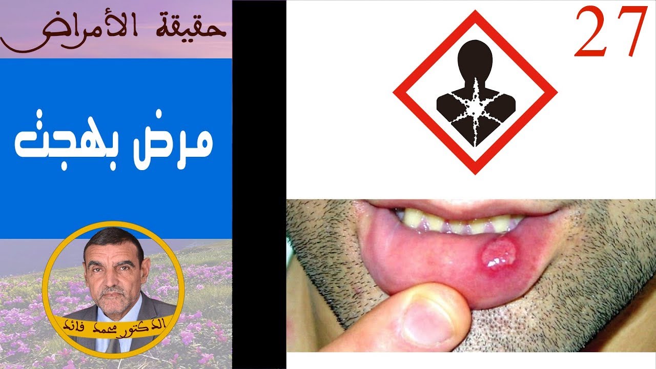 حقيقة مرض بهجت  | الدكتور محمد فائد