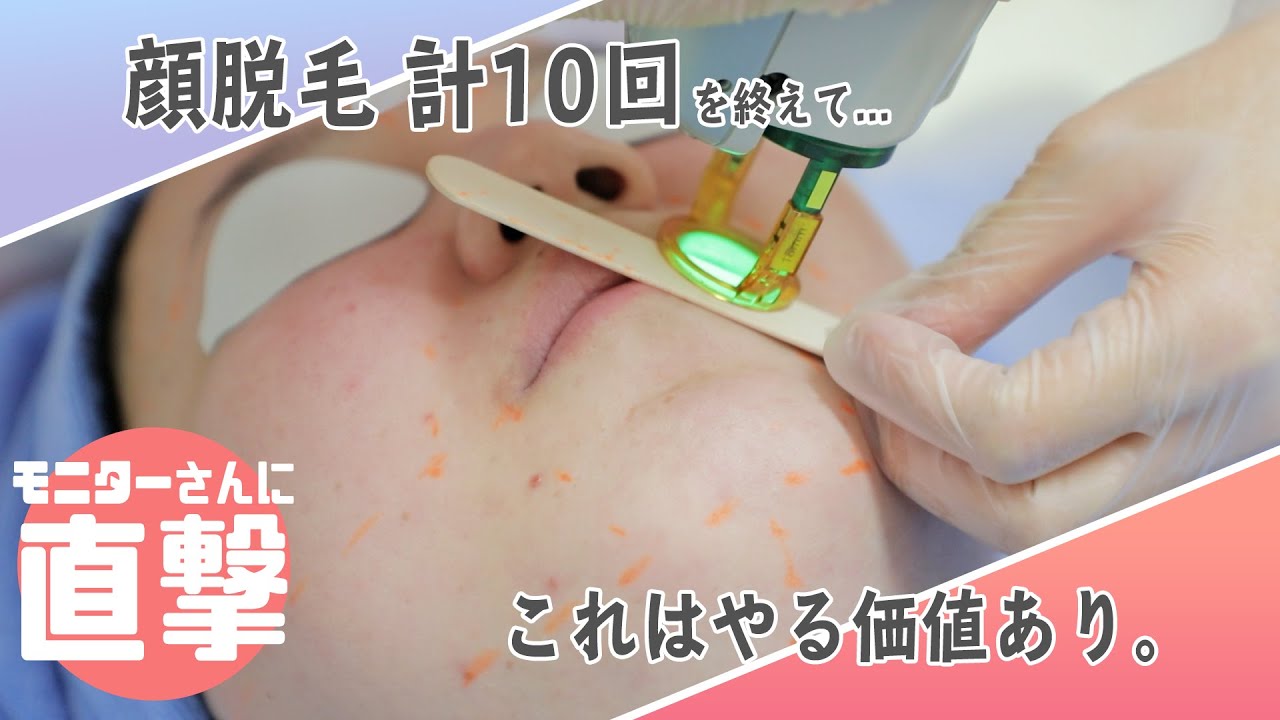 【顔脱毛#4】医療脱毛10回の効果とは…結局、何回必要？産毛に効果はあるの？