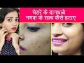 चेहरे के दाग धब्बे नमक से कैसे हटाए | How to Remove Dark Spots using Salt | Hindi Video Mp3