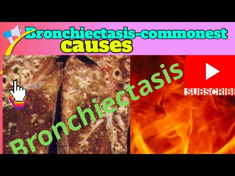 Bronchiectasis-commonest causes. 5 lethal consequences of untreated Bronchiectasis-usmle, neet pg