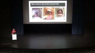 Mpox Clade Ib First Case in the Americas-Emerging infection response