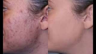 How to Parmanently Remove Pimple, Acne, Pimple Marks Completely | Anindita Banerjee