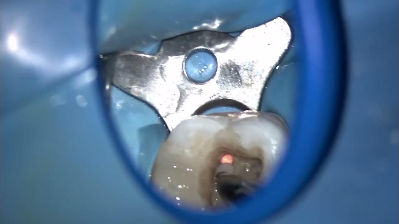 Endodontic Coronal Seal YouTube