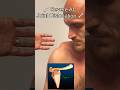 Severe AC Joint Dislocation Explained by Surgeon ⚕️