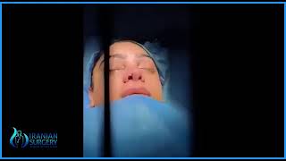 Rhinoplasty In Iran Before And After Video