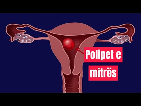 Video: A duhen hequr polipet endometriale?