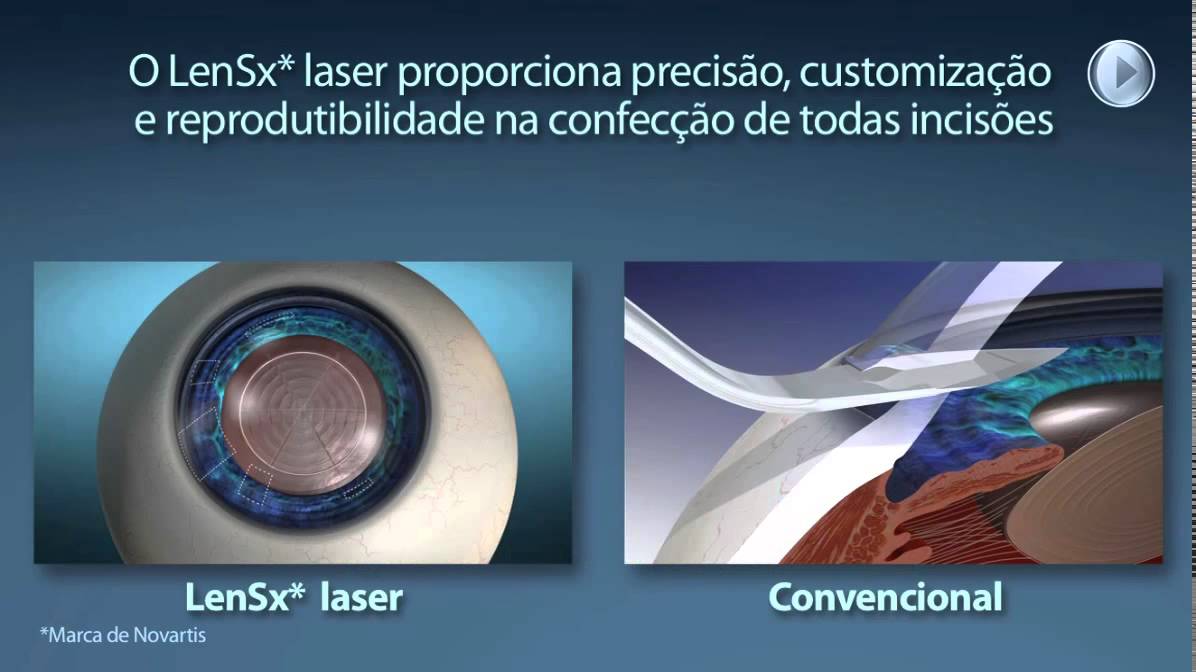 Cirurgia de catarata a laser - LENSX LASER SYSTEM - ALCON - YouTube