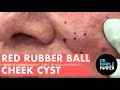 Red Rubber Ball Cheek Cyst