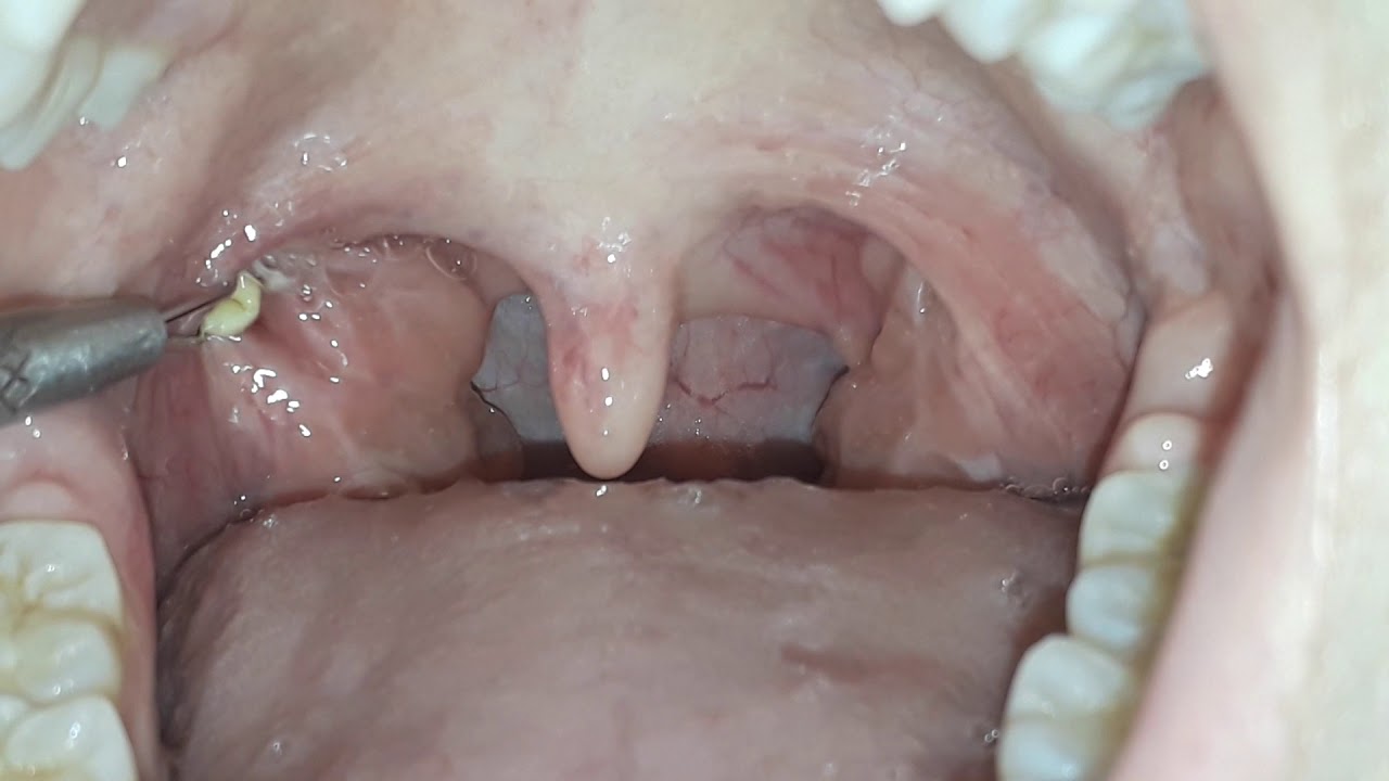 Many tonsil stones 