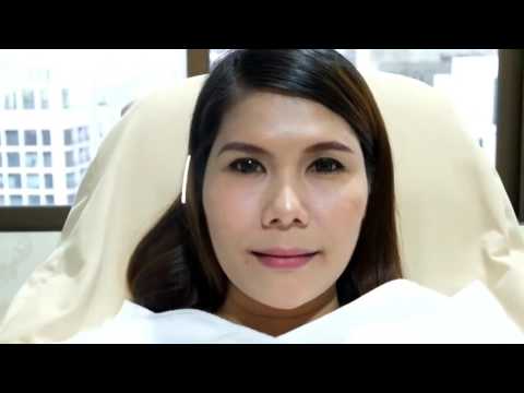 Lipo Lifting ยกกระชับบริเวณโหนกแก้มด้วยไหม PDO | Waleerat Clinic