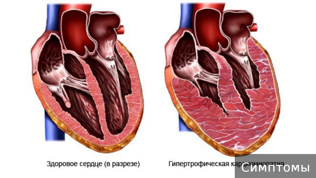 Миокард левого предсердия. Гипертрофическая кардиопатия. Гипертрофия миокарда, Бычье сердце. Бычье сердце кардиомиопатия.