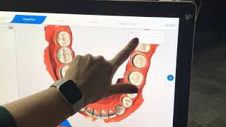 CEREC Primescan using cut tool screenshot 1