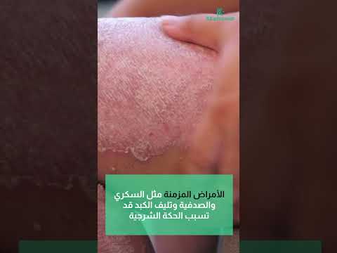 4 مسببات للحكة الشرجية