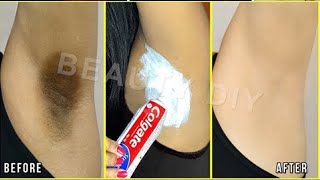 In Just 5 Minutes Whitening Dark Underarm Challenge Underarms Whitening Home Remedy 100% Works