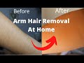 Ketchbeauty at home laser hair removal results before and after