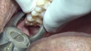 ⁣Decayed upper wisdom tooth extraction