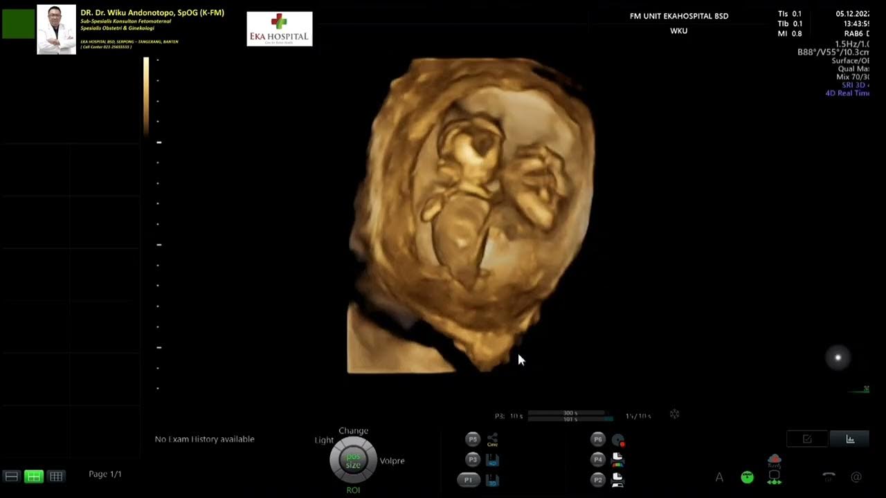 TRAP SYNDROME (Twin Reversed Arterial Perfusion Syndrome) Dr Wiku