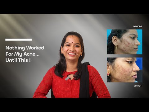 Tejaswini Finally Found a Solution for Stubborn Pimples