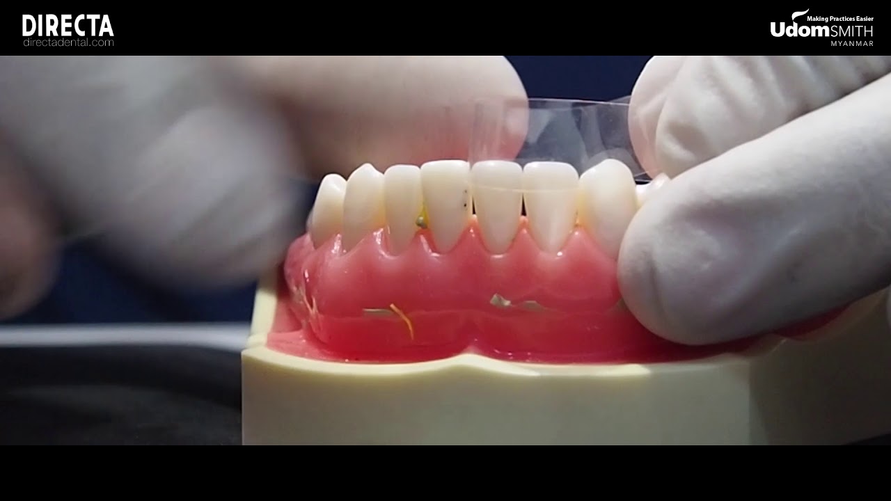 Direct Dental Group Direct Strips (Straight/Curved) application by