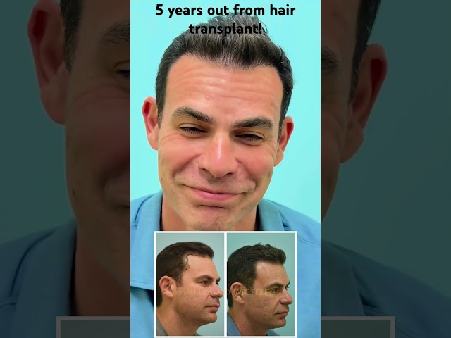 5 years out from hair transplant with close-up comb through result of hairline and temporal points