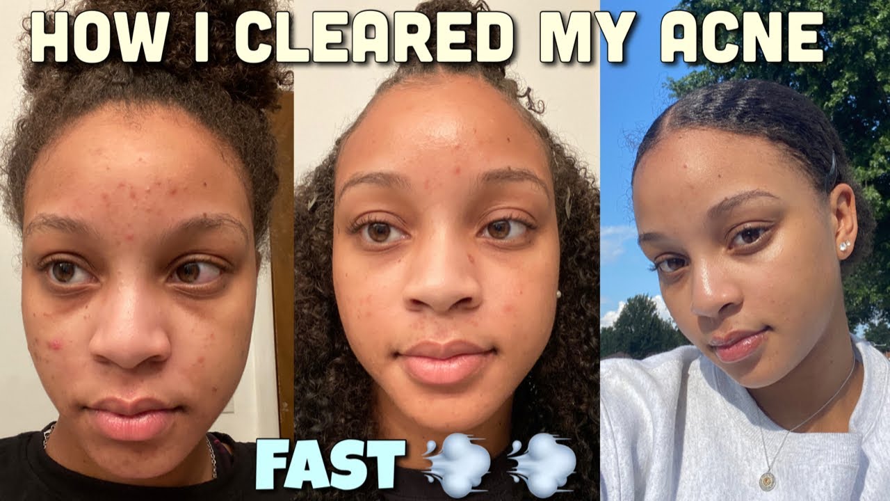 How to Get Clear Skin 2021