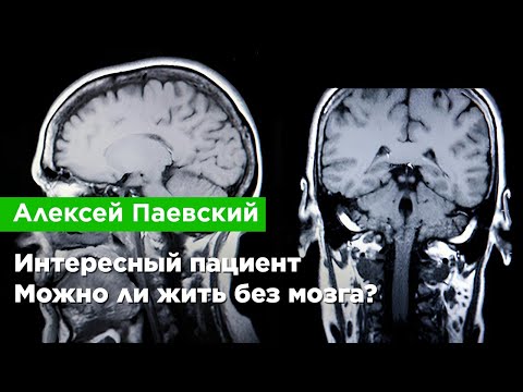 Алексей Паевский — Интересный пациент. Можно ли жить без мозга?