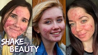 Living With Acne | SHAKE MY BEAUTY