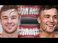 One Year Teeth Transformation  // FULL Invisalign Experience
