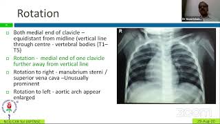 Chest Xray in Pediatrics - Dr. N.C. Gowrishankar