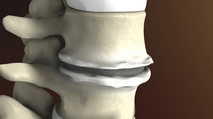 Degenerative Disc Disease (Spondylosis) explained by Spine Surgeon Dr. Jessica Shellock Plano, TX - DayDayNews