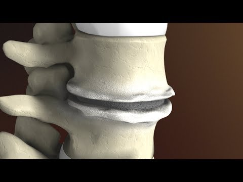 Degenerative Disc Disease (aka: Spondylosis) explained by Dr. Jessica Shellock