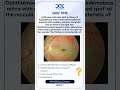FMGESpotCheck | Common Ophthalmoscopic Findings Series