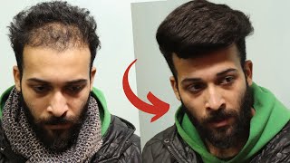 Best Hair Patch in pakistan | New Hair Image what’s App No 00923004368792 | screenshot 3