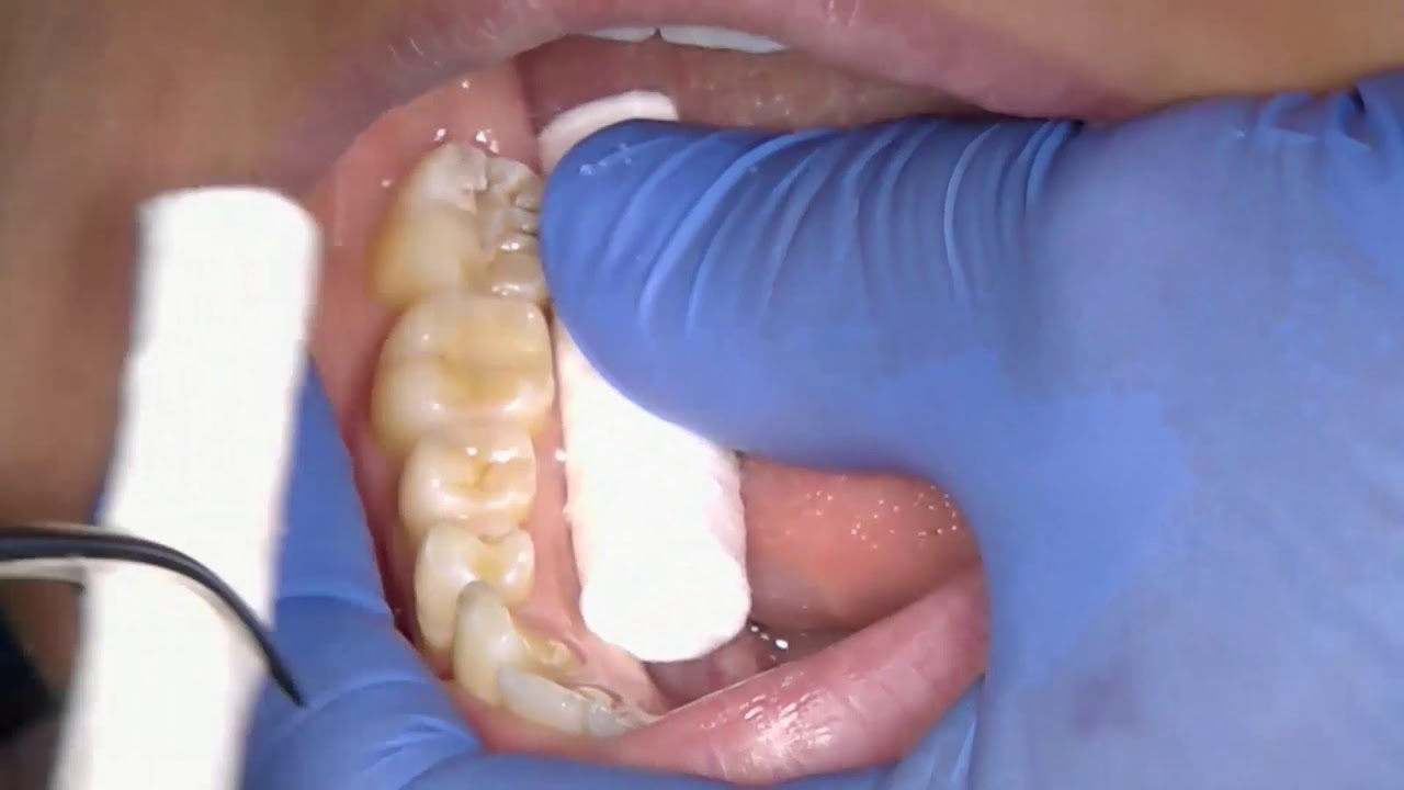 Clinical Demonstration of Resin Fissure Sealant Placement on tooth 47