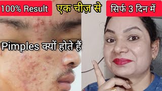 How To Remove Pimples Overnight | Pimples Removal | Remove Pimples Overnight | Acne Treatment