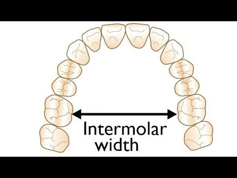 Measurement of Intermolar Width on a Model for Orthodontic Treatment by Dr. Mike Mew