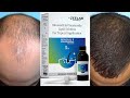 Cheapest Minoxidil 5 in India | ZEELAB Pharmacy Minoxidil Review | Best Minoxidil For Hair Regrowth
