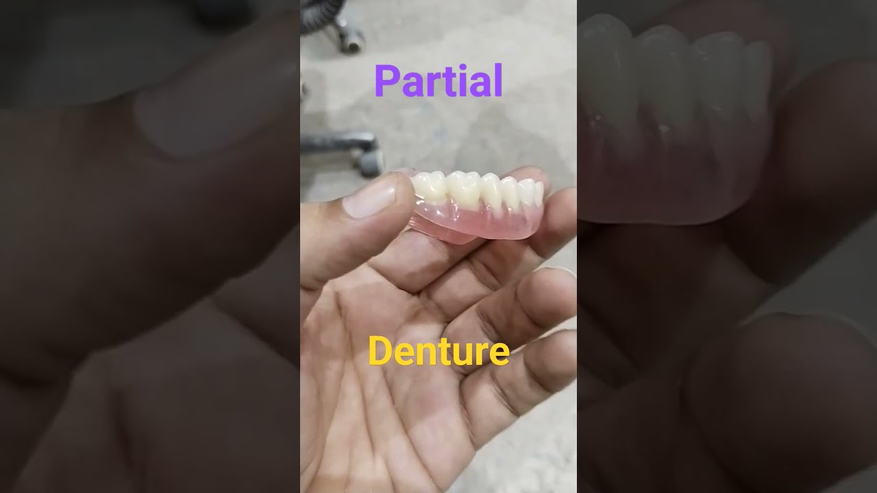 Upper Removable Partial Denture By Haider Dentalartbyhaider Dentures Rpd Dentur Orthodontic